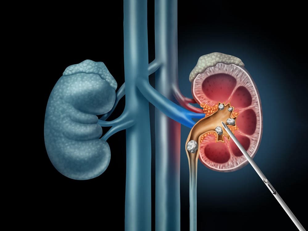 PCNL kidney stone surgery