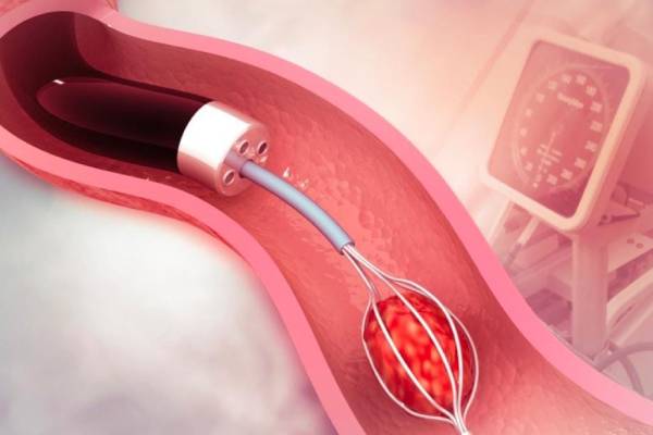 RIRS retrograde intrarenal surgery