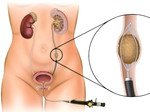 URSL ureteroscopic lithotripsy procedure