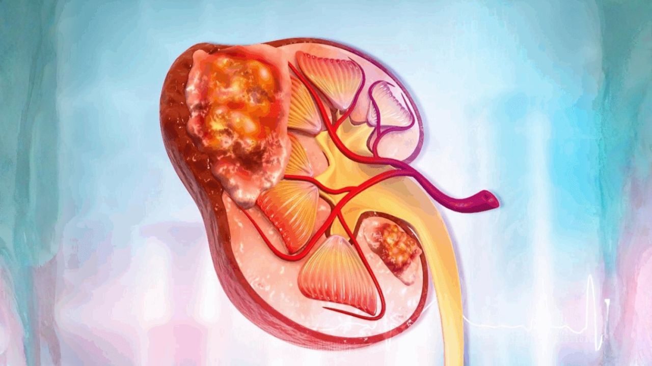 Kidney Tumour Treatment