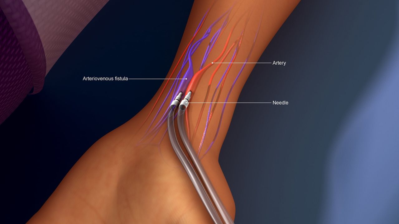 AV Fistula