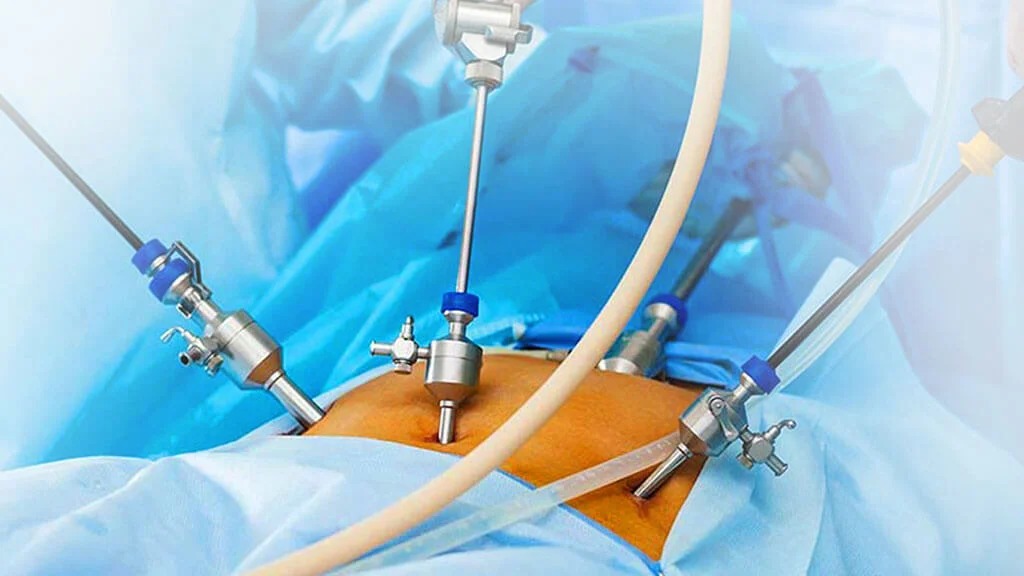 Laser stone surgery procedure at CKD & Urology India